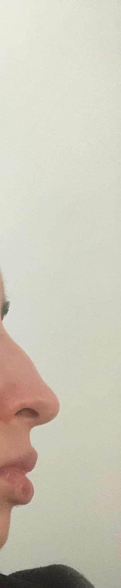 Burun estetiği için bu burun dolgu ile düzeltilebilir mi yoksa ameliyat şart mı?