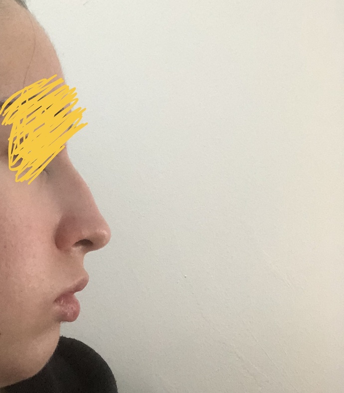 Burun estetiği için bu burun dolgu ile düzeltilebilir mi yoksa ameliyat şart mı?