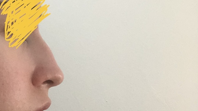 Burun estetiği için bu burun dolgu ile düzeltilebilir mi yoksa ameliyat şart mı?