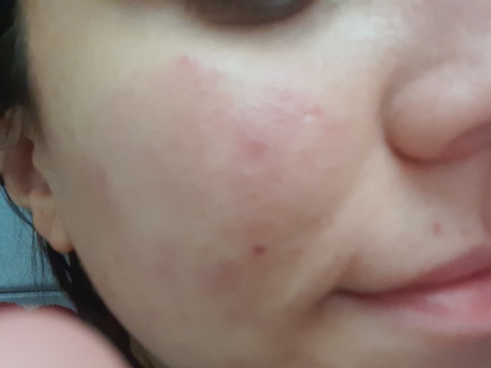 Cildimde 20 dk buz gezdirdim böyle oldu, ne yapmam lazım? Geçer mi🥺?
