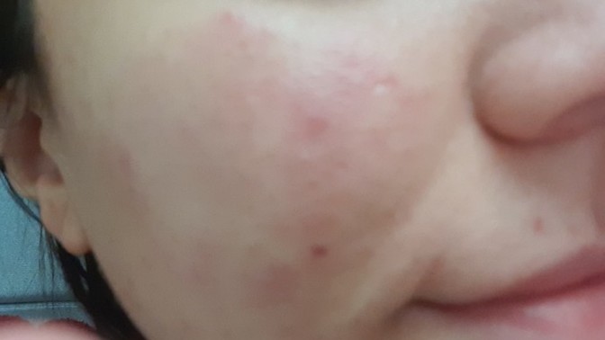 Cildimde 20 dk buz gezdirdim böyle oldu, ne yapmam lazım? Geçer mi🥺?
