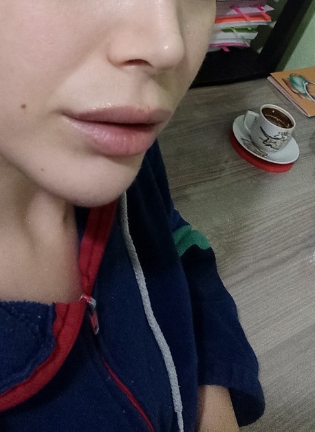 Burun estetiğimin üzerinden iki buçuk yıl geçti sizce ucu top gibi mi?