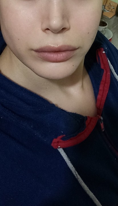 Burun estetiğimin üzerinden iki buçuk yıl geçti sizce ucu top gibi mi?