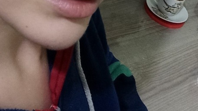 Burun estetiğimin üzerinden iki buçuk yıl geçti sizce ucu top gibi mi?