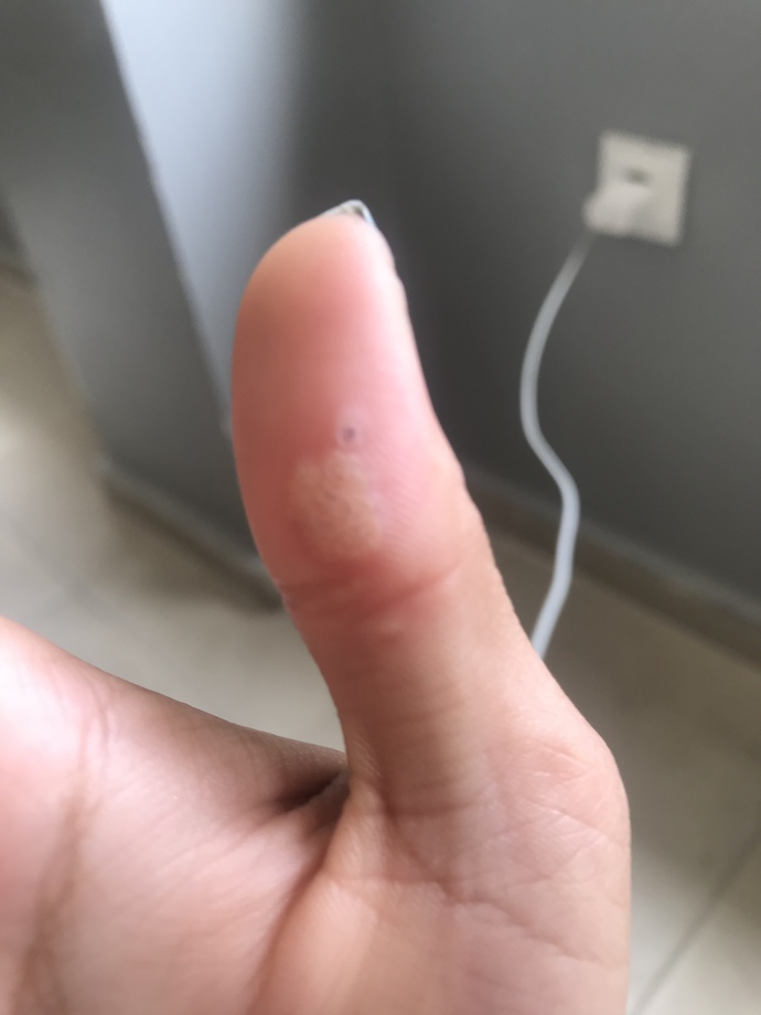 Siğiller nasıl geçecek?
