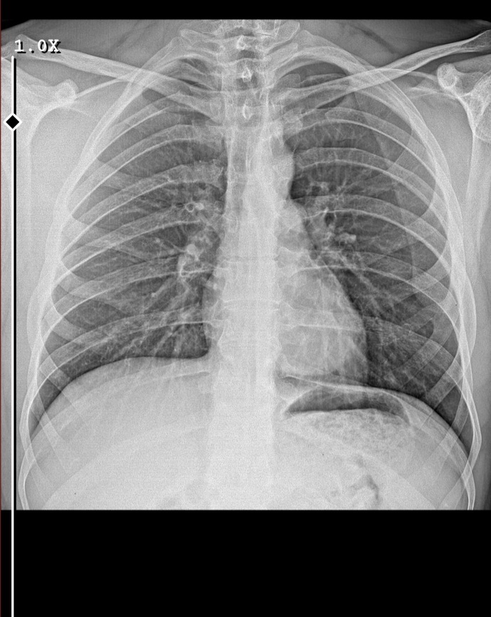 Anlayan var mı doktor hastalık ciğerlerine inmiş dedi ama ne olduğunu söylemedi?