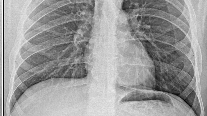 Anlayan var mı doktor hastalık ciğerlerine inmiş dedi ama ne olduğunu söylemedi?