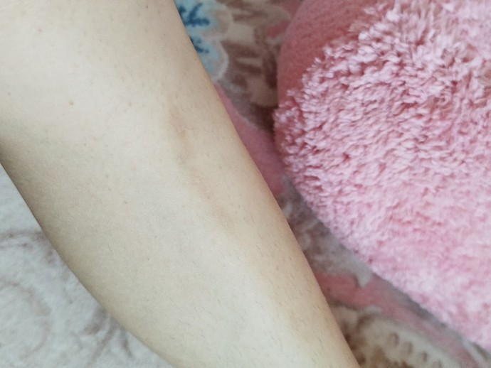 Jiletle bacağımı kestim ve böyle bir iz estim böyle bir iz kaldı sizce geçer mi?