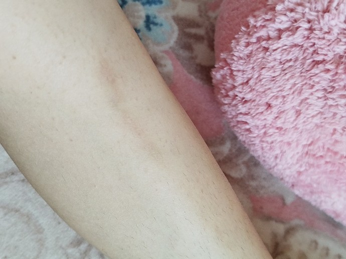 Jiletle bacağımı kestim ve böyle bir iz estim böyle bir iz kaldı sizce geçer mi?