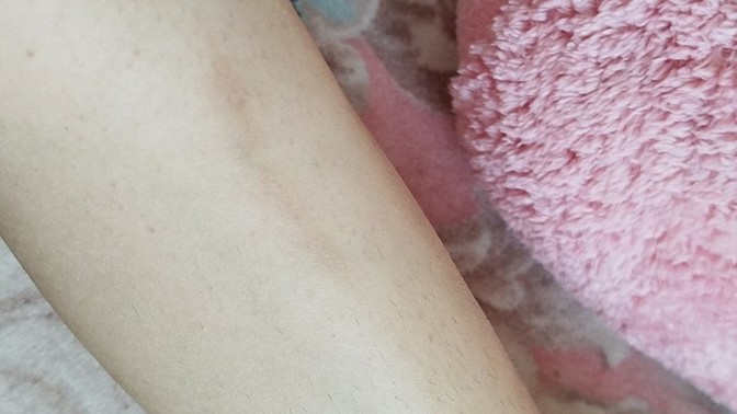 Jiletle bacağımı kestim ve böyle bir iz estim böyle bir iz kaldı sizce geçer mi?