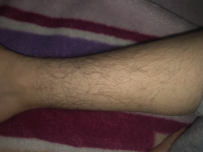 Sorum kadınlara bu kadar tüylenme olması kadın için normal mi? cevaplandırmadan önce detayı okursanız çok sevinirim?