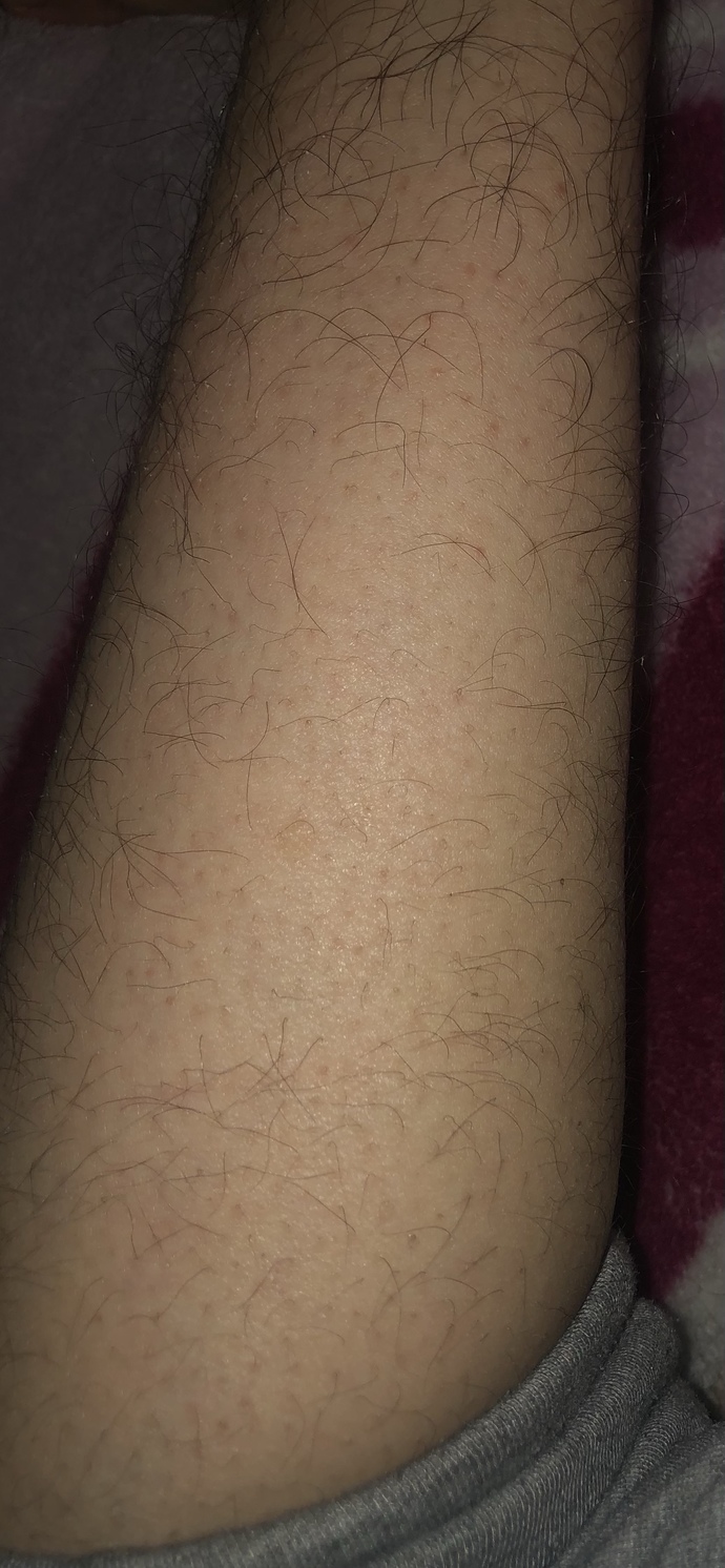 Sorum kadınlara bu kadar tüylenme olması kadın için normal mi? cevaplandırmadan önce detayı okursanız çok sevinirim?