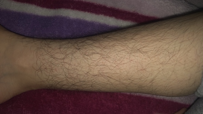 Sorum kadınlara bu kadar tüylenme olması kadın için normal mi? cevaplandırmadan önce detayı okursanız çok sevinirim?