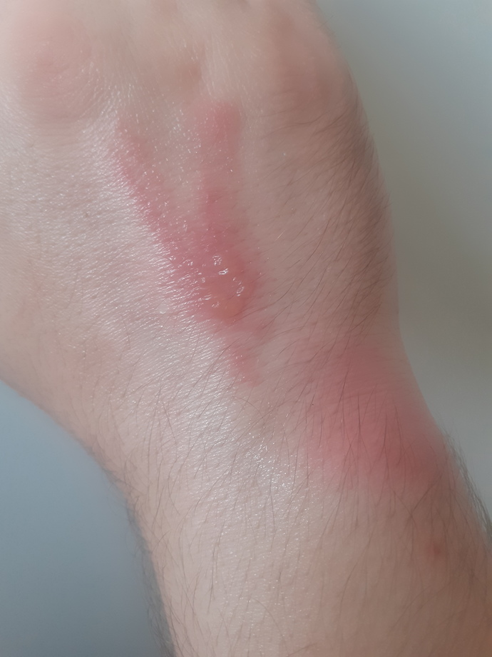 Yaban arısı sokması sonucu su toplaması normal midir?