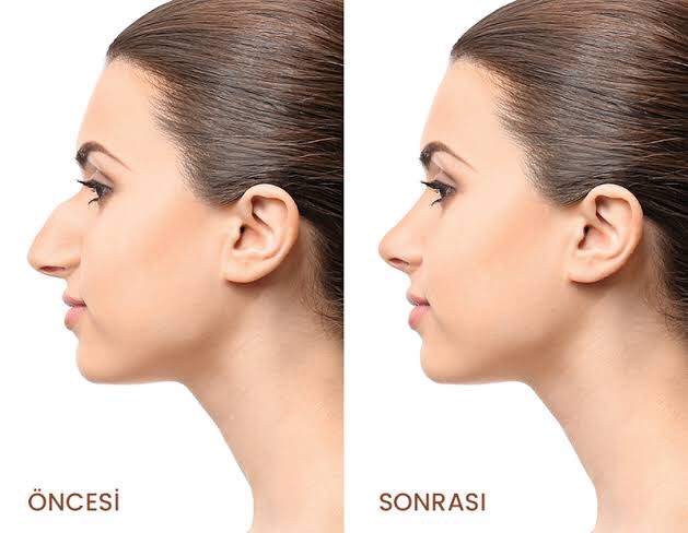 Allah’ın verdiği burunla hayatına devam eden insan kaldı mı?