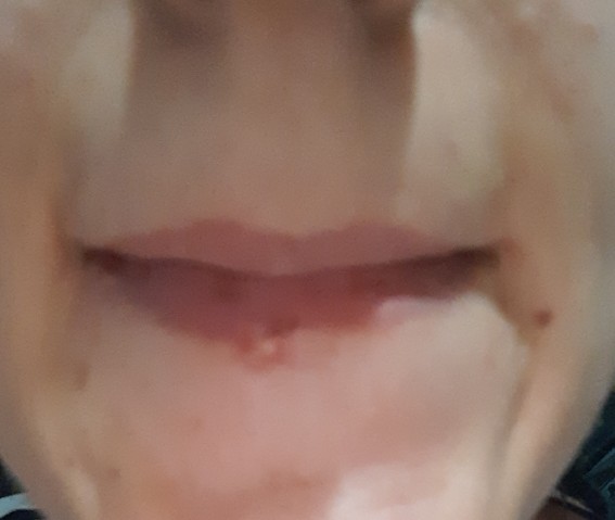 Arkadaşlar alt dudağımda çıkan sivilce nasıl geçer?