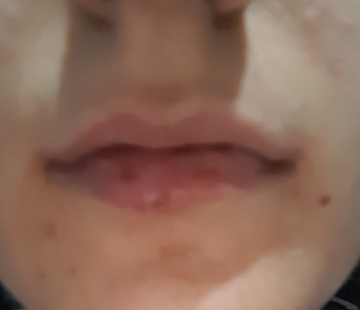 Arkadaşlar alt dudağımda çıkan sivilce nasıl geçer?