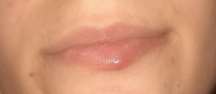 Kızlar ya bu sivilce mi çıban mi nedir niye geçmiyor 🥺?