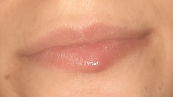 Kızlar ya bu sivilce mi çıban mi nedir niye geçmiyor 🥺?