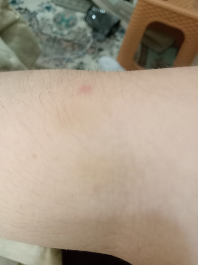 Ben kaşıntısı ve morarma?