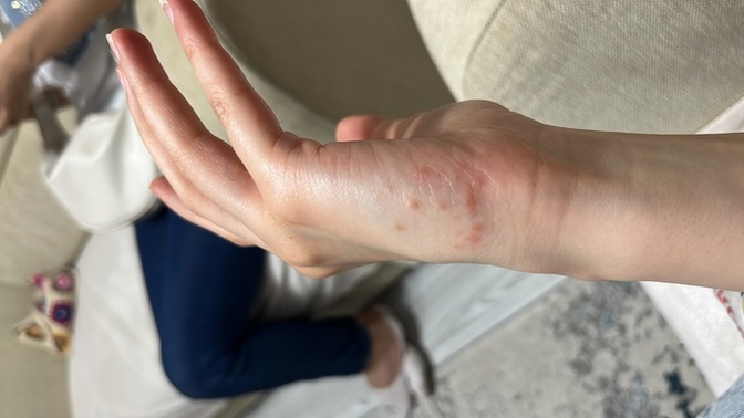 Elimdeki bu sivilce egzama mı, alerji mi yoksa uyuz mu?