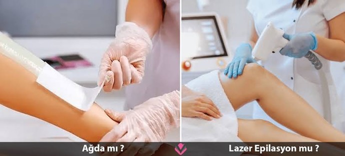 Ağda mı, lazer mi?