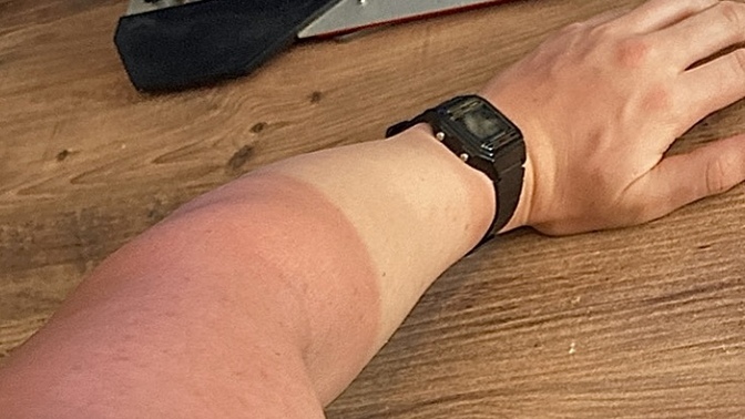 Kimler bugün güneş kremi sürmeyi unuttu 🧴?