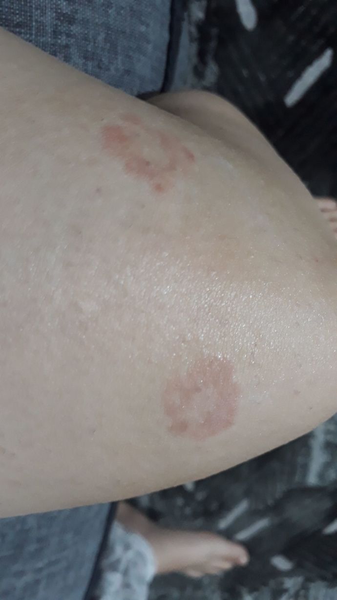 KKizlar aranızda doktor varsa acil bana yardım eder mısınız kan tahlili nasil yapilit bana mantar kapti?