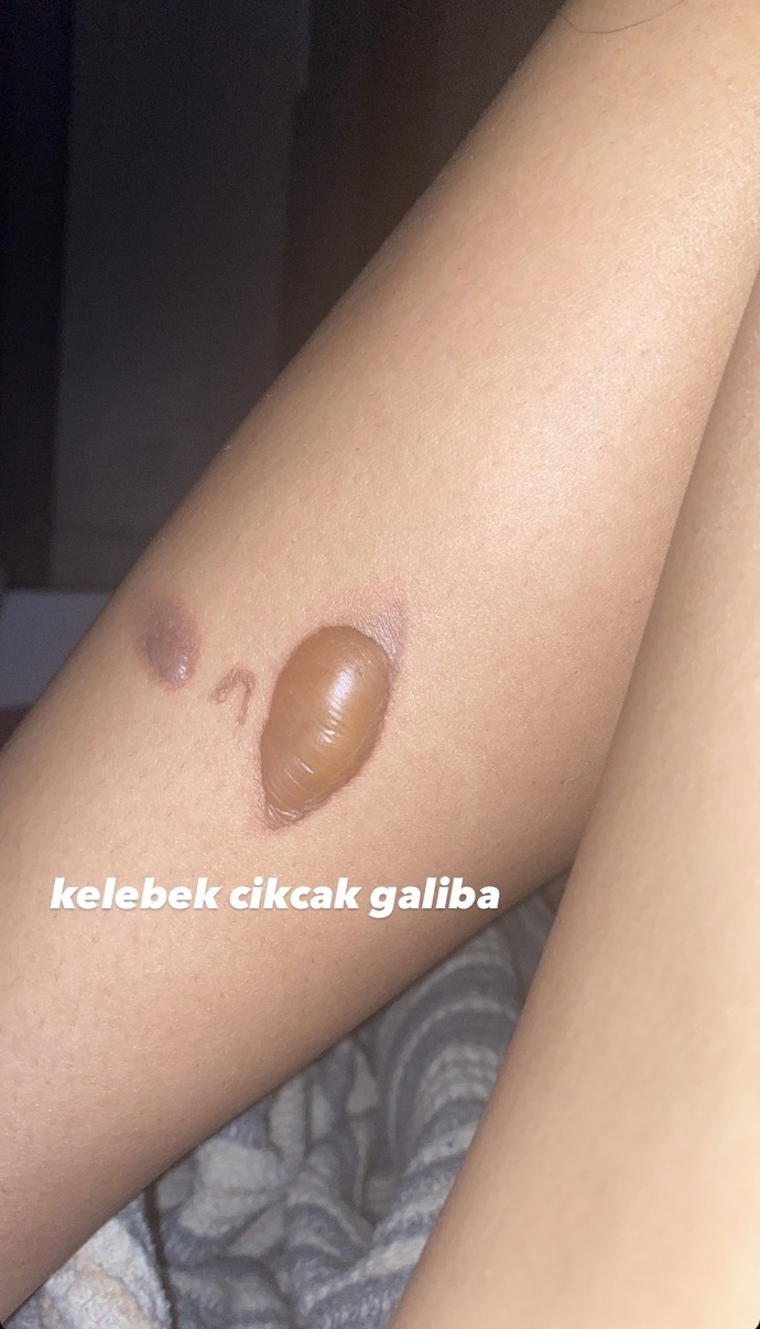 Bacagim motor egzozuna değdi?