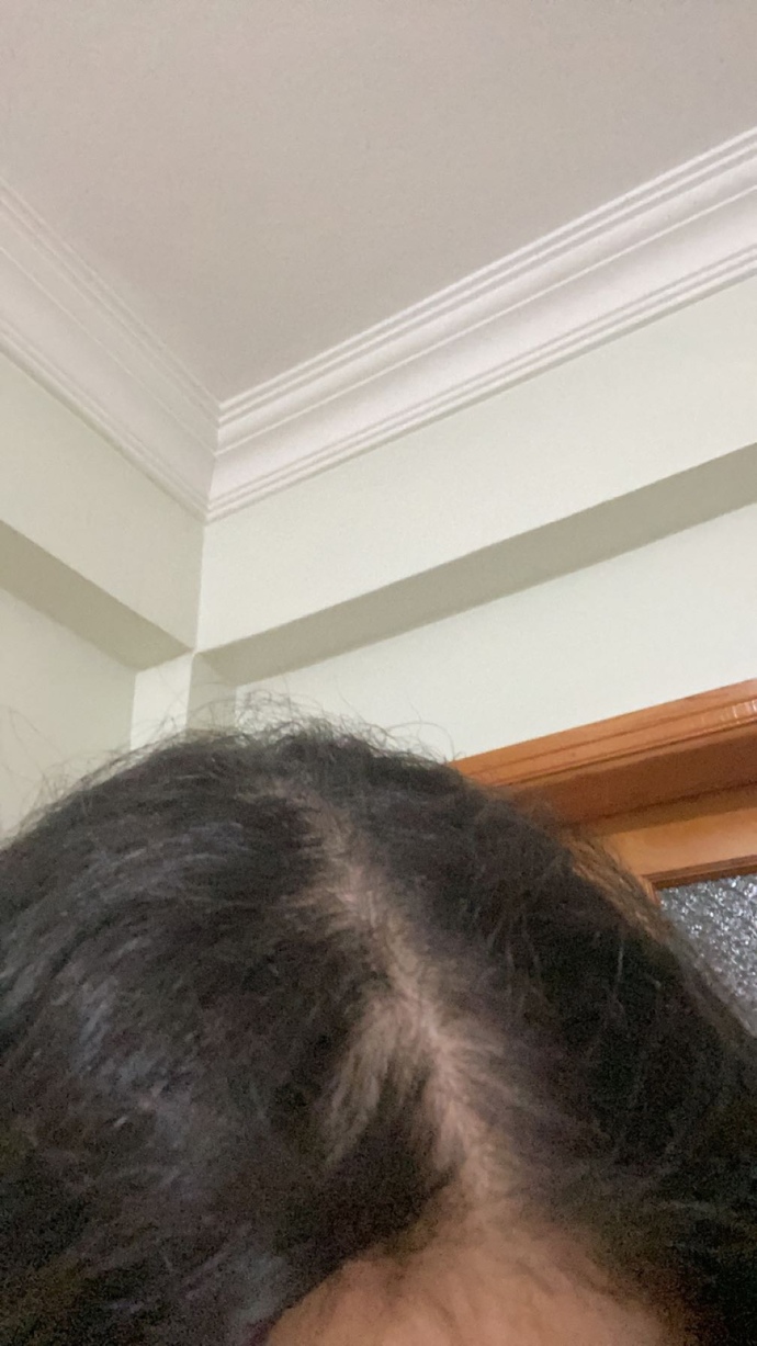 Saçlarda niye böyle açılma olur?