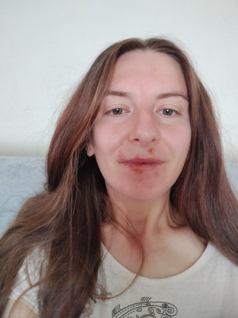 Selam uçukçıktı nasıl geçer?
