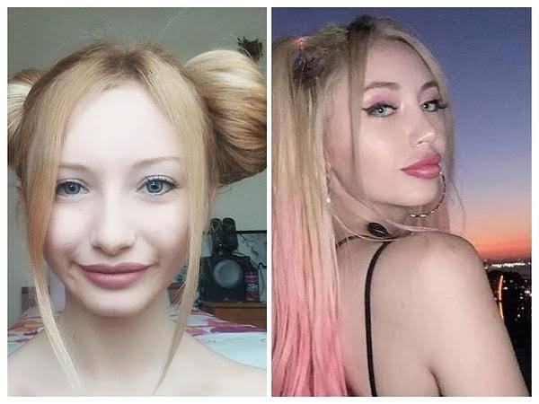 Estetik yapanlar neden inkar ediyor yaptırmadık diye sizce?