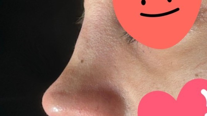 Burun ameliyati oldum sizce burnum nasıl olmuş?
