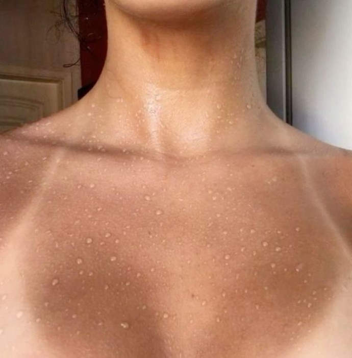 Güneşlenme sonucu oluşan yanık izleri güzel mi sizce ✨️?