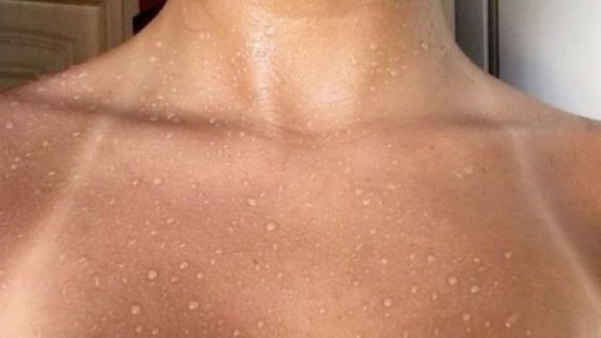 Güneşlenme sonucu oluşan yanık izleri güzel mi sizce ✨️?