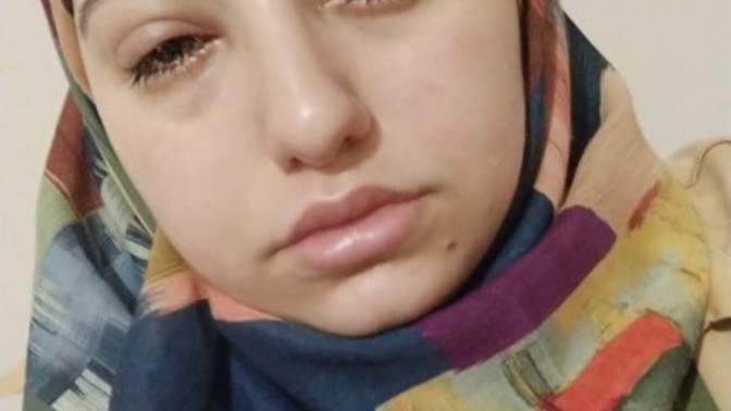 Göz nezlesine ne iyi gelir gözlerim çok kötü oldu sabahtan beri düzelmiyor?