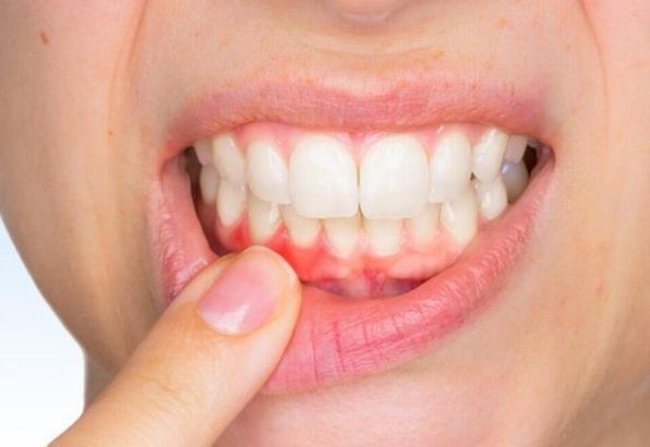 Diş eti problemi ve diş eti çekilmesi yaşayan var mı?