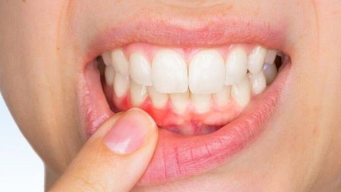 Diş eti problemi ve diş eti çekilmesi yaşayan var mı?