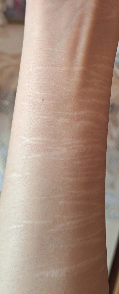 Kolda bu sekilde faca izlerinin olmasi is verilmesine engel mi?