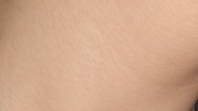 Boynumda sivilce çıktı ve dokununca acıyor?