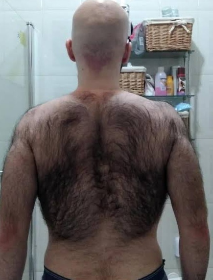 Sırtım fazla kıllı ne yapmalıyım?