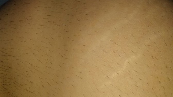 Diz kapağımdaki bu çatlakların nedeni nedir?