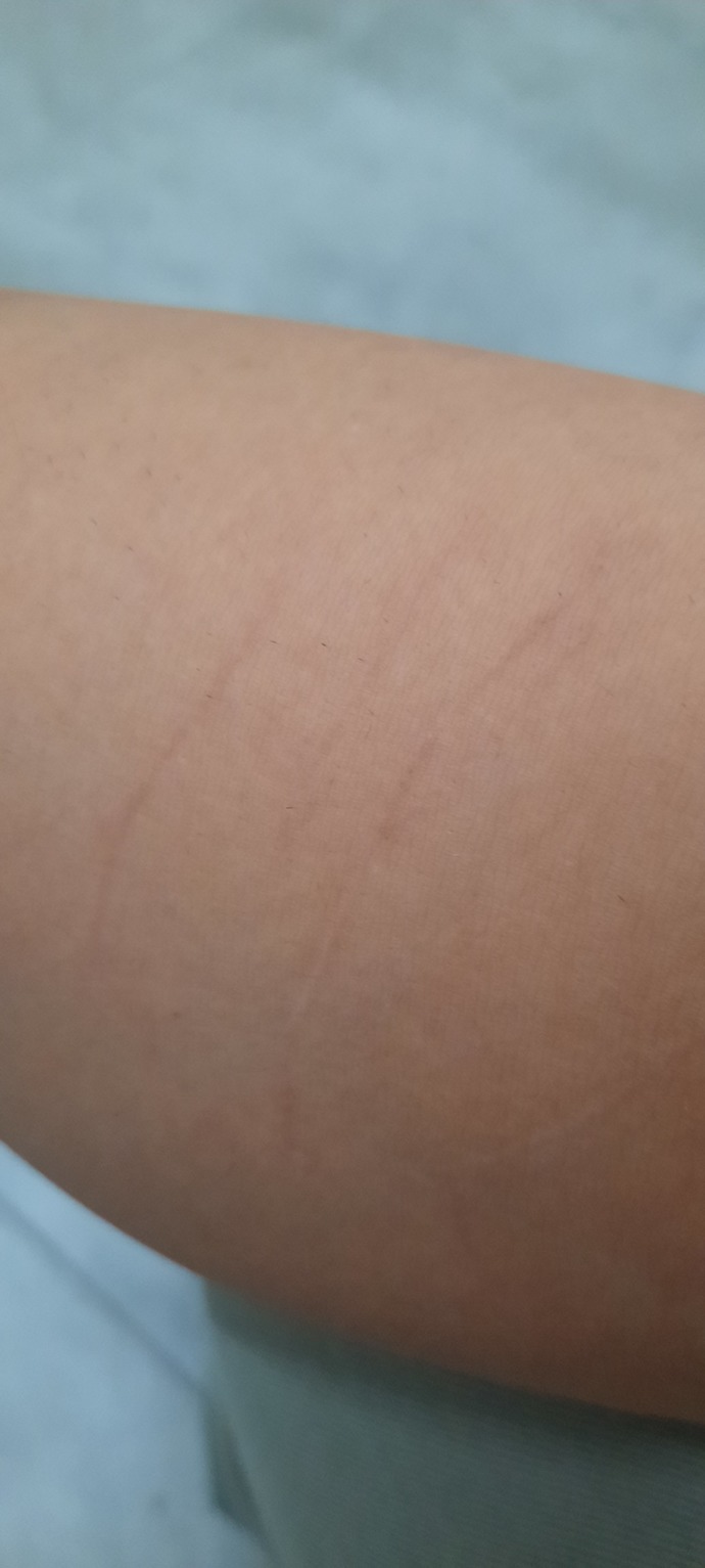 Barfiks çekiyorum kollarımda yırtılmalar oldu bu geliştiğini mi gösterir?