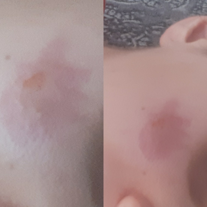 Yanakta ki sivilce morluğu nasıl geçer?