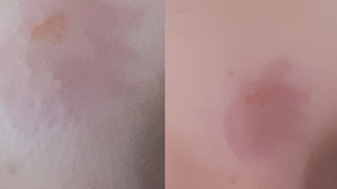 Yanakta ki sivilce morluğu nasıl geçer?
