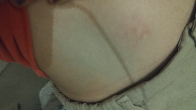 Apandistim patlamış olabilir mi bakar mısınız?