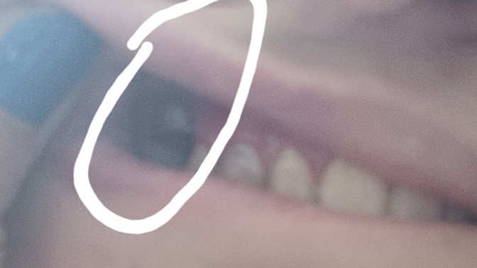 Arkadaslar öncelikle böyle bi resim için özür dilerim ama benim sorunum süt dışım çıkmamış küçüklükten beri orada kalmış?