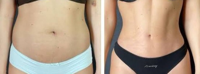 Liposection yaptıran var mı?
