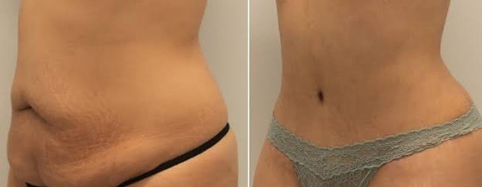 Liposection yaptıran var mı?