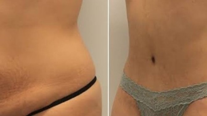 Liposection yaptıran var mı?